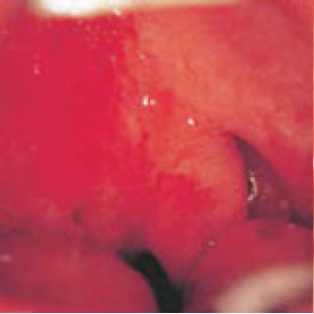 扁桃周囲膿瘍（右）